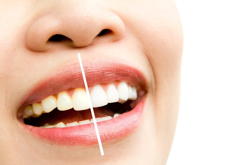 how much is it to whiten teeth at dentist in Canberra