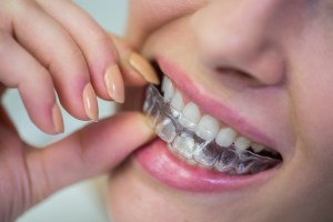 price of clear aligners