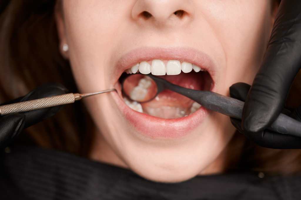dental erosion