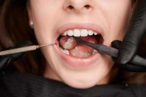 dental erosion
